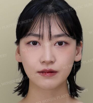 輪郭整形 AFTER