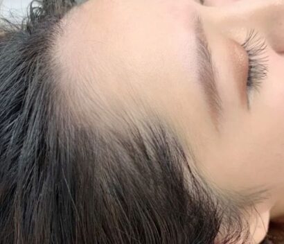 Hairline BEFORE