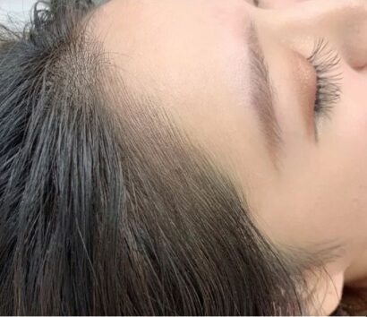 Hairline AFTER