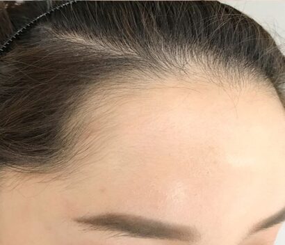 Hairline BEFORE