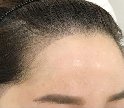 Hairline AFTER