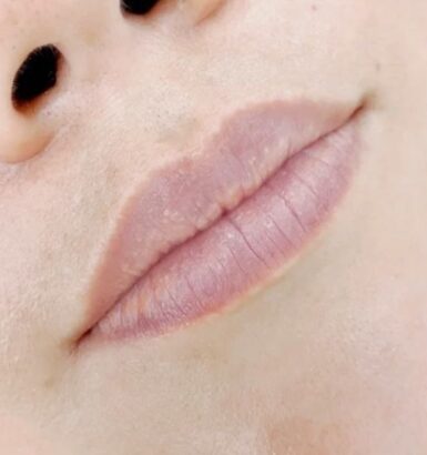 Lip BEFORE