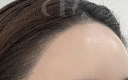 HAIRLINE AFTER