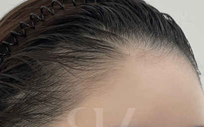 HAIRLINE BEFORE