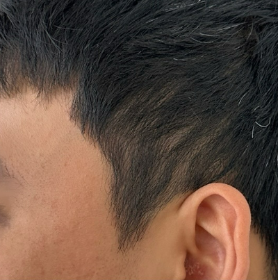 ヘアラインアートメイク BEFORE