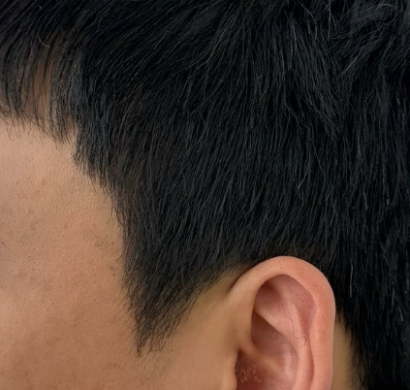 ヘアラインアートメイク AFTER